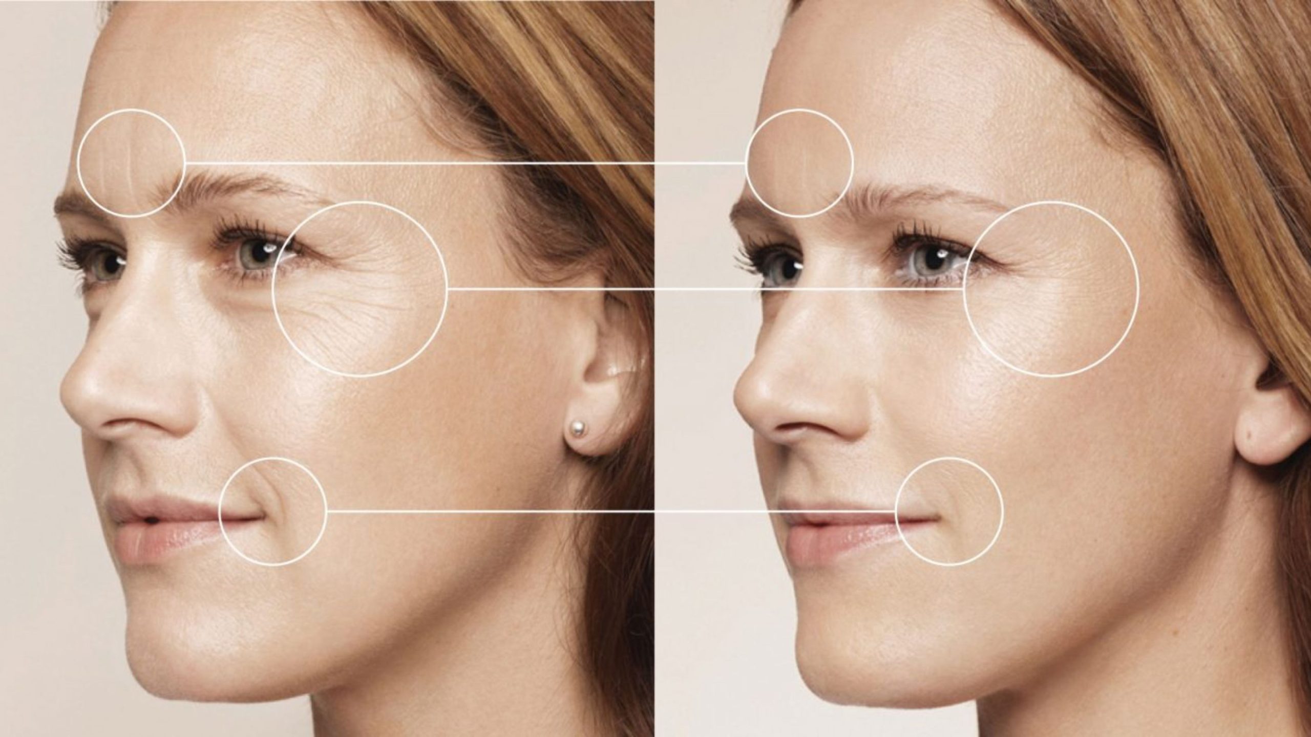 Hiệu quả điều trị của HIFU